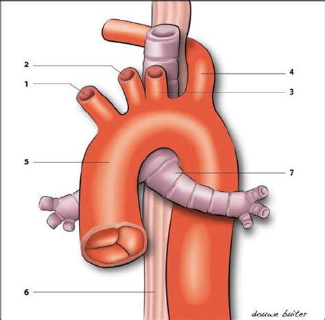 Right Aortic Arch With Aberrant Left Subclavian