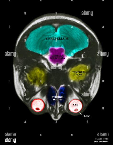 MRI scan of the brain, with the major structures labeled Stock Photo ...