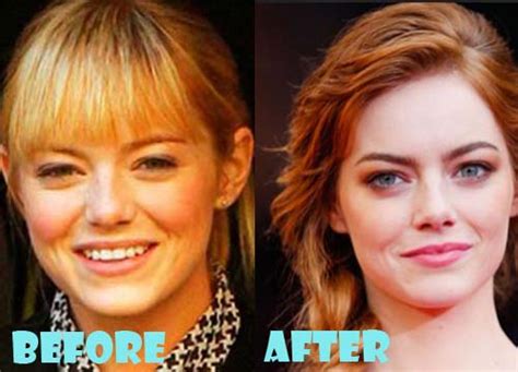 Emma Stone Plastic Surgery Before and After Nose Job - Lovely Surgery