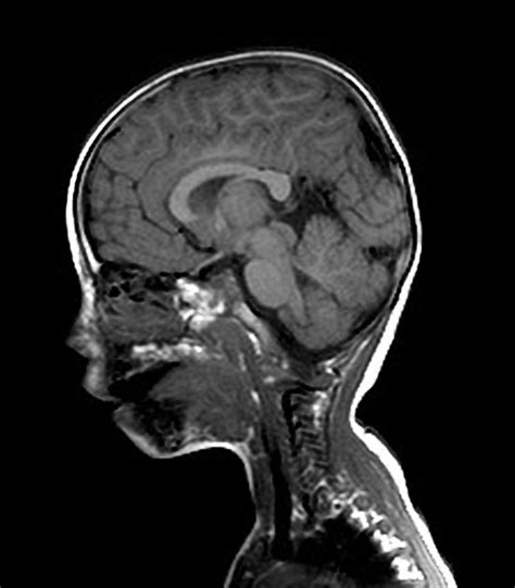 Cerebellar Tonsils Mri