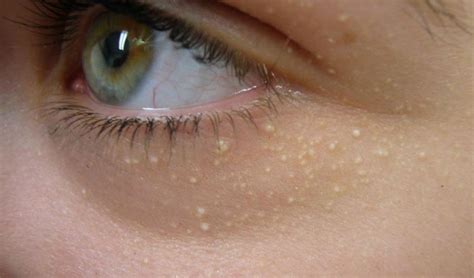 7 Home Remedies for Milia White Spots Under Eyes - Skincarederm