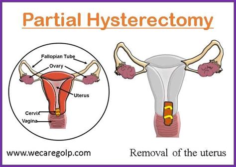 Hysterectomy: Types, Procedures, Complications - We Care