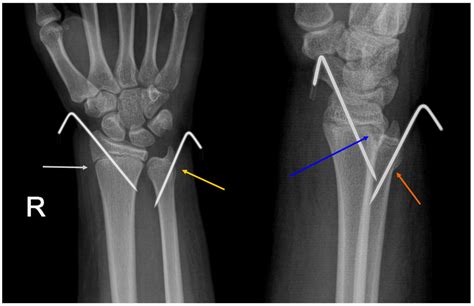 What Is An Epiphyseal Fracture With Pictures - vrogue.co