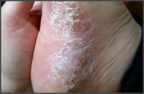 psoriasis on soles of feet pictures | Psoriasis expert