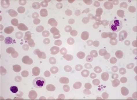 Blood picture of normocytic normochromic blood picture with severe... | Download Scientific Diagram