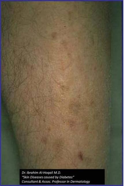 Black Spots On Legs Diabetes - DiabetesWalls