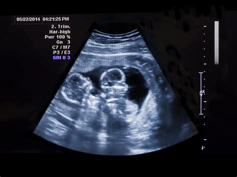 What scans will I have if I'm expecting twins? | BabyCentre