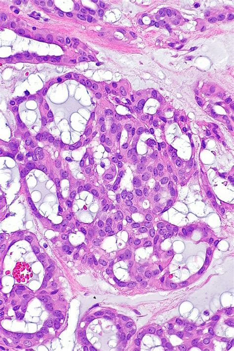 Cribriform pattern - Libre Pathology