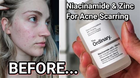 I TESTED THE ORDINARY NIACINAMIDE AND ZINC SERUM FOR MY ACNE SCARS FOR 1 MONTH - YouTube