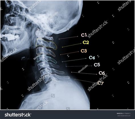 22,000 Cervical Spine Image Images, Stock Photos & Vectors | Shutterstock