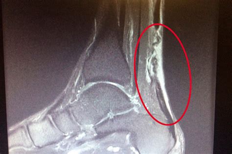 Achilles Tendon Repair – Dr. Richard Zell