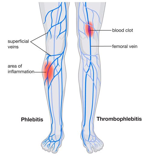 Phlebitis and Blood Clots - Preferred Vascular Group