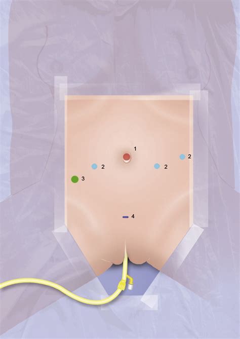 Robot-assisted Laparoscopic Approach for Artificial Urinary Sphincter ...