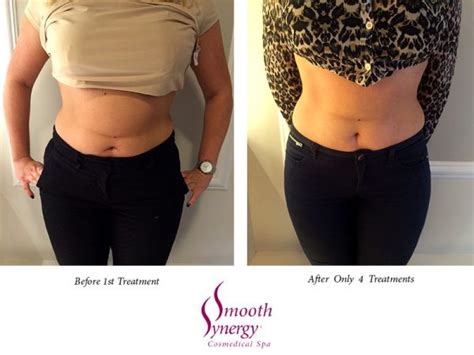 Ultrasonic Lipo Cavitation Treatments - Smooth Synergy Medical Spa & Laser Center