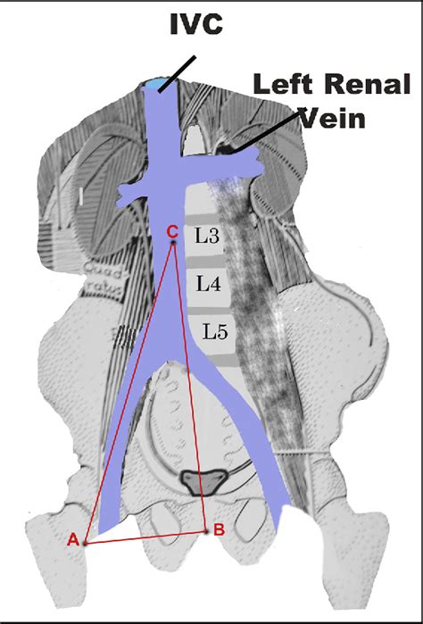 Figure 1 from Inferior vena cava filter placement at bedside using computed tomography scan ...