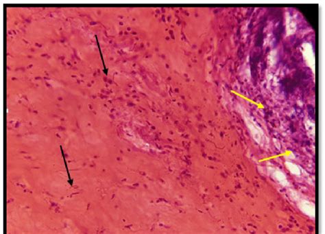 Histological section of the lung shows a severe fibrinous exudate that ...