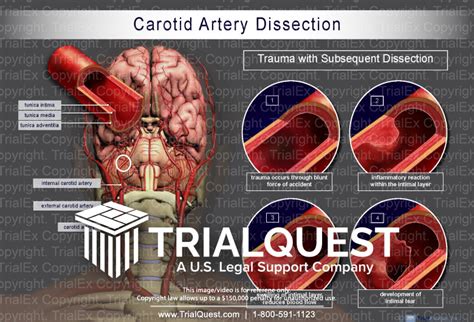 Carotid Artery Dissection - TrialQuest Inc.