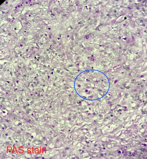 Cryptococcus Neoformans Mucicarmine Stain