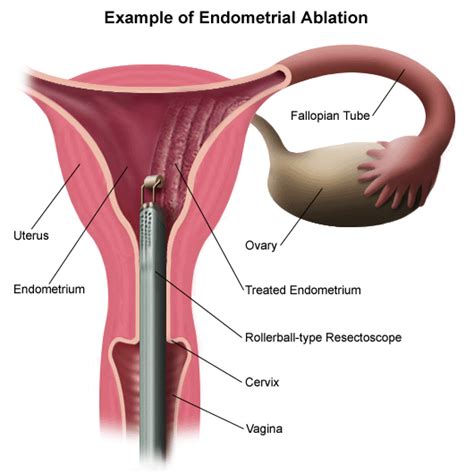 Endometrial Ablation - Newton-Wellesley Hospital - Greater Boston Area