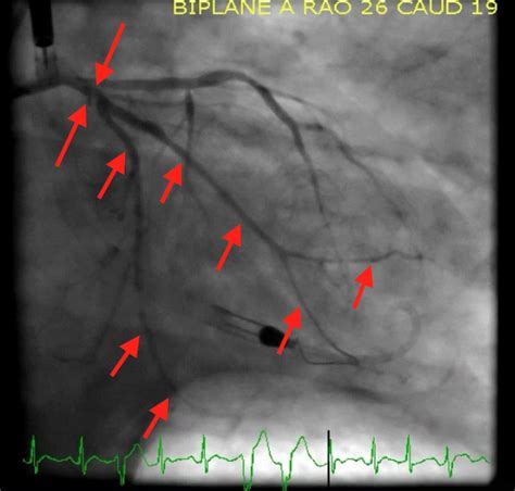 Dr. Smith's ECG Blog: May 2018