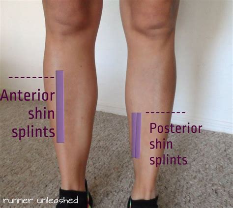 Pin on Shin Splints Symptoms