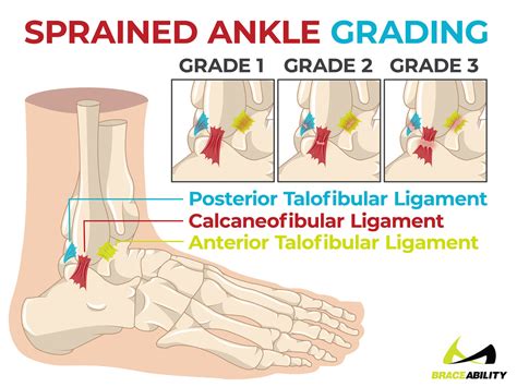 Grade 2 Anterior Talofibular Ligament Tear : Ankle Sprains Northcote The Foot And Ankle Centre ...