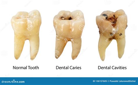 Normal Tooth , Dental Caries and Dental Cavity with Calculus . Comparison between Difference of ...