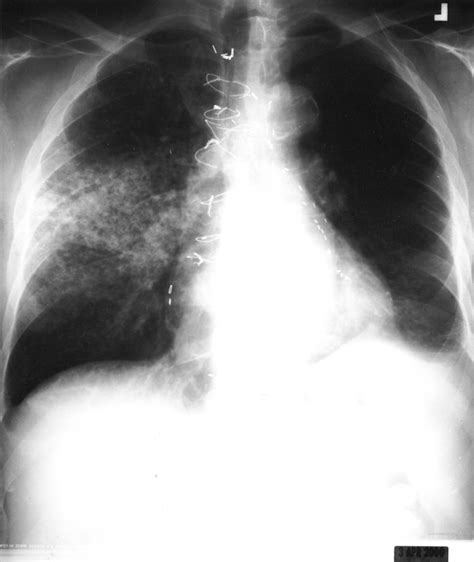 Migratory pulmonary infiltrates in a patient with rheumatoid arthritis -- Mehandru et al. 57 (5 ...