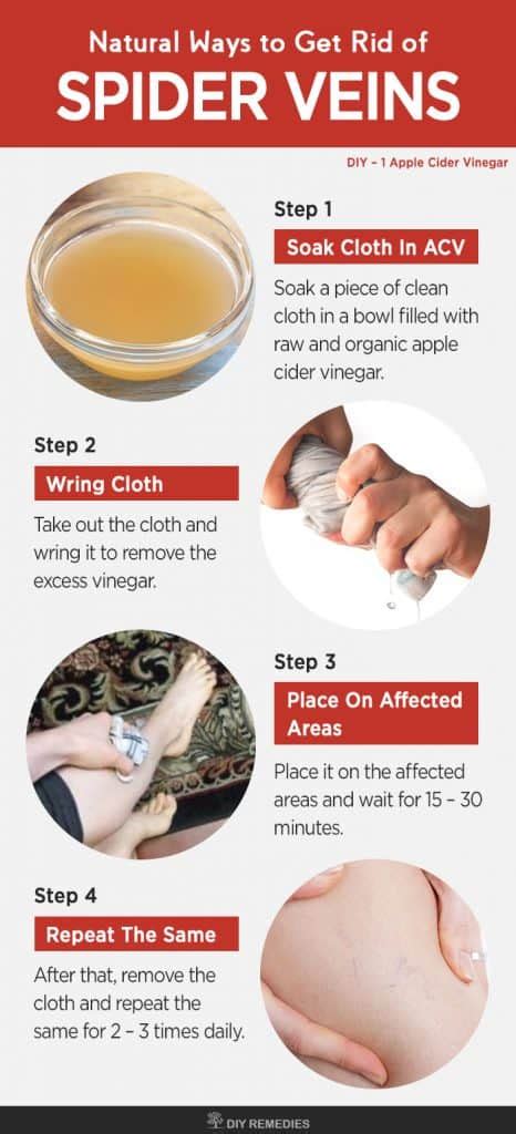 Natural Ways to Get Rid of Spider Veins