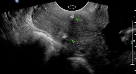 Value of transvaginal sonography after cervical cerclage - Bronshtein ...