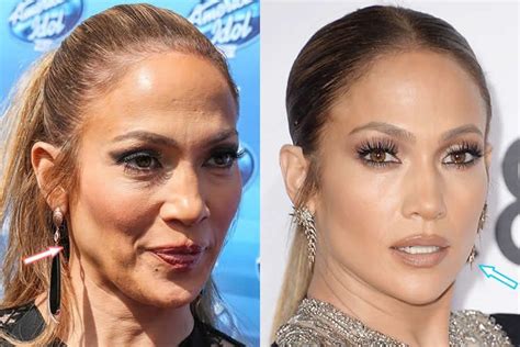 Jennifer Lopez - botox & facelift - before and after #LipFillersBeforeAndAfter in 2020 ...