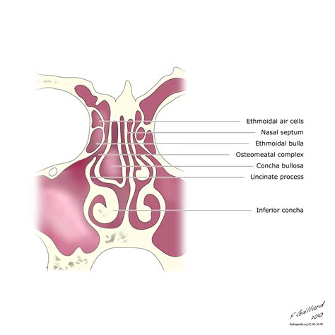 Concha bullosa - Do you suffer from persistent nose block?