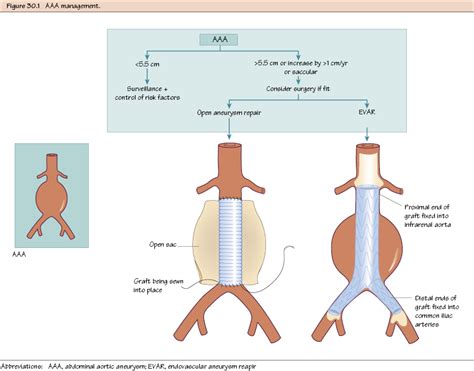 Abdominal Aortic Aneurysm II: Treatment | Thoracic Key