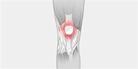 Patellofemoral Pain Syndrome - Vive Health