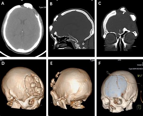 Frontiers | Relapse of skull osteoma after hydroxyapatite cement cranioplasty: Case Report