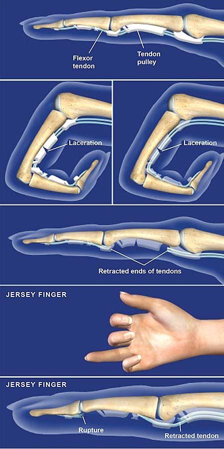 Flexor Tendon Injuries | Central Coast Orthopedic Medical Group