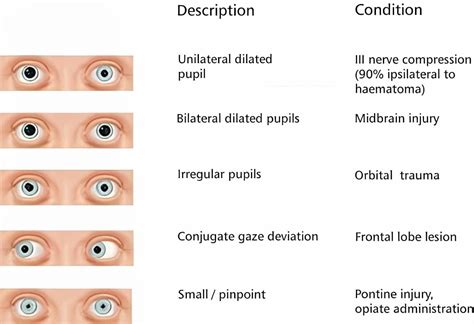 Free Printable Pupil Size Charts [PDF] & Actual Size, MM, Scale