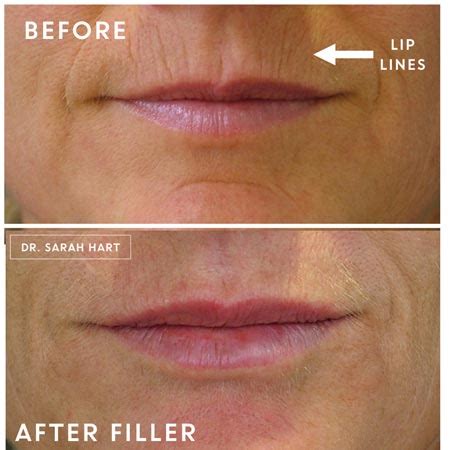 Botox For Lip Lines Before And After | Sitelip.org