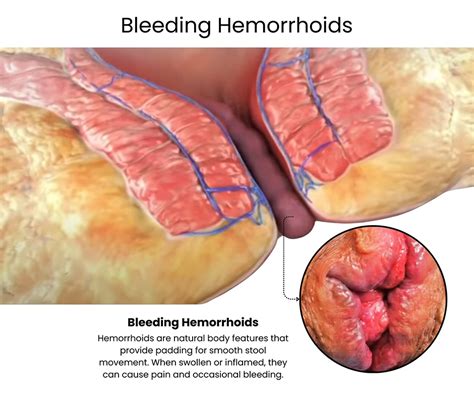 How to Treat Bleeding Hemorrhoids - Downtown Vein & Vascular