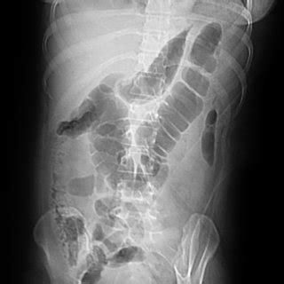 17: Colon cut-off sign on plain X-ray abdomen | Download Scientific Diagram