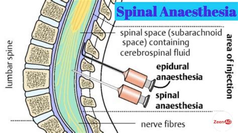 Spinal Landmarks And Epidural Contrast Spread Pattern - vrogue.co