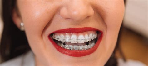 Brace Yourself for the Perfect Smile – How Braces Work | Hamburg Dental ...