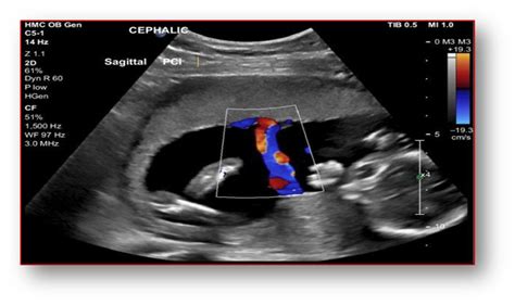 Fetal Doppler Ultrasound - Bacc Hospital 2024