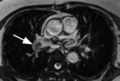 MR Imaging of Pulmonary Embolism: Diagnostic Accuracy of Contrast ...