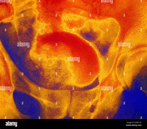 Enlarged prostate: false-colour intravenous urogram (IVU) showing an enlarged prostate, which ...