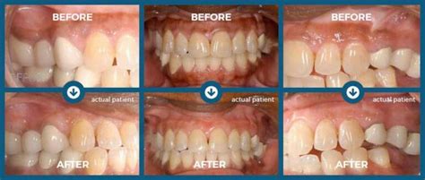 Gum Depigmentation Memphis TN | Laser Gum Bleaching