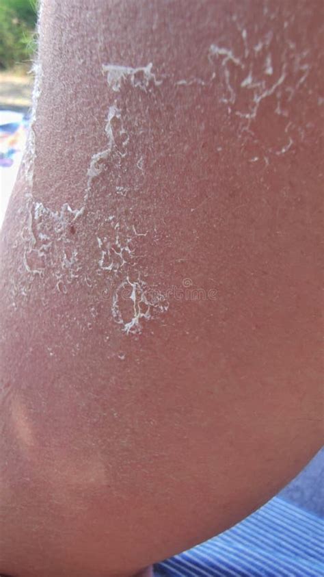 Skin on the Arm that is Peeled Off Due To Sunburn Stock Photo - Image of medical, sunburned ...