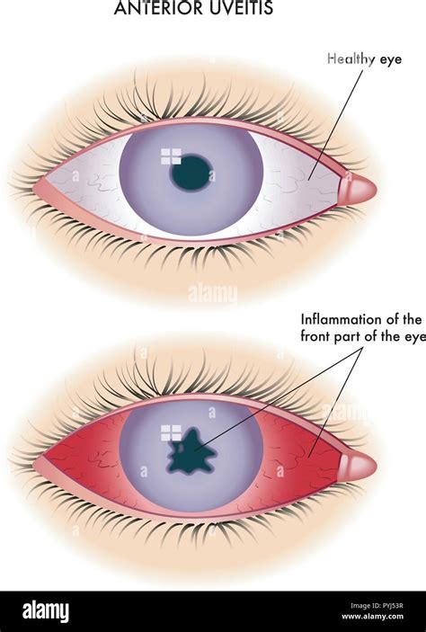 Uveitis posterior Stock Vector Images - Alamy