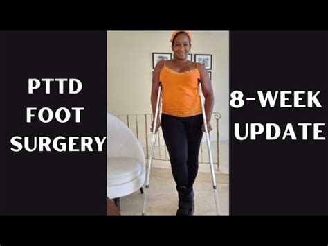 PTTD Foot Surgery Update 8 Week Post Op - YouTube