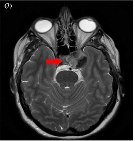 Cureus | Isolated Third Nerve Palsy as a Rare and Solo Presentation of ...